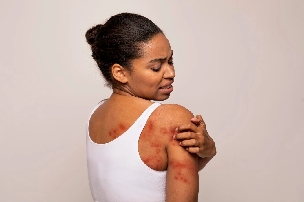 A woman in a vest checking a rash from dermatitis on her back